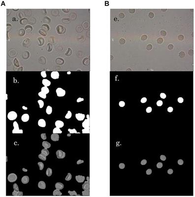 Computerized Morphometric Analysis of Eryptosis